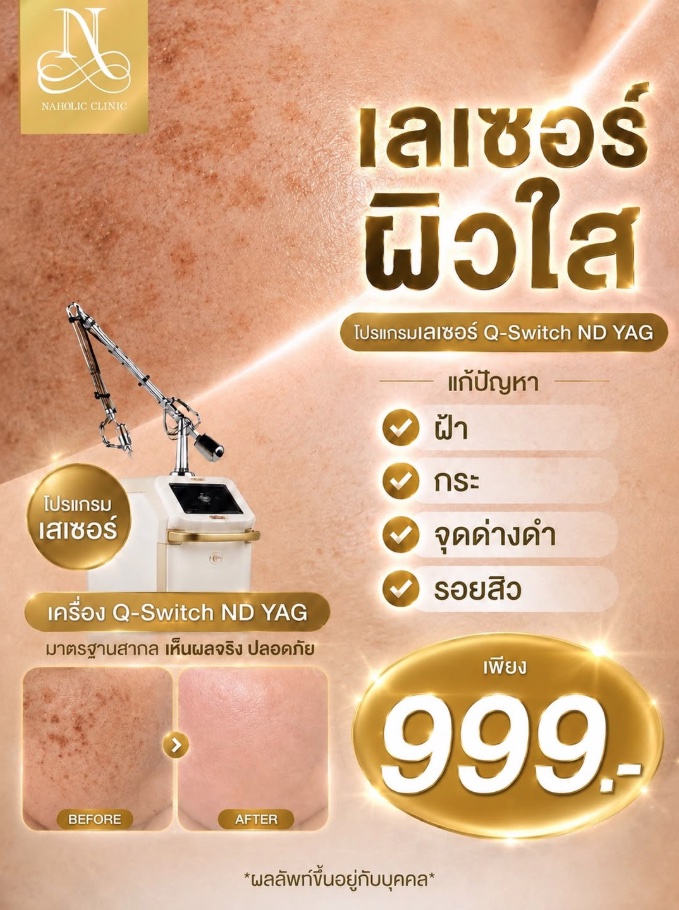 โปสเตอร์เลเซอร์ผิวใส Q-Switch ND YAG แก้ปัญหาฝ้า กระ จุดด่างดำ รอยสิว ราคา 999 บาท